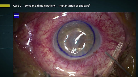 EyeYon Medical: New Approach for Corneal Healing